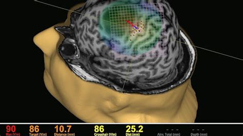 neuroclast|Nexstim nTMS .